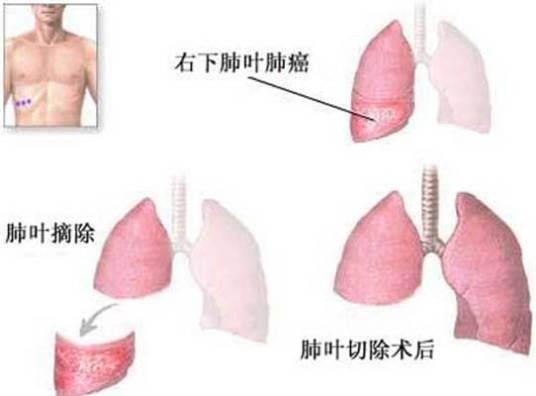 肺叶切除术