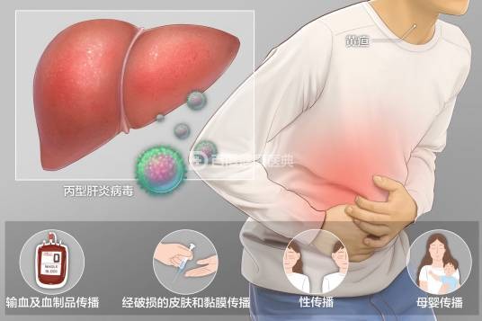 丙型病毒性肝炎