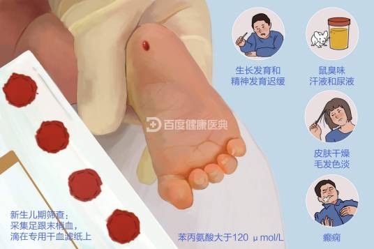 苯丙酮尿症