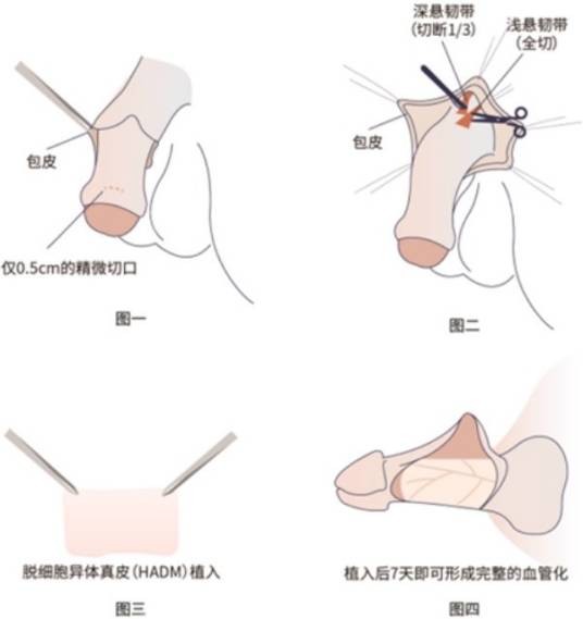 阴茎延长