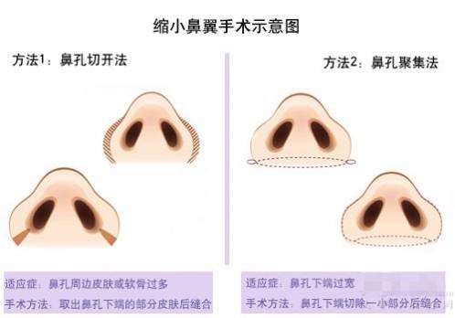 鼻翼缩小手术