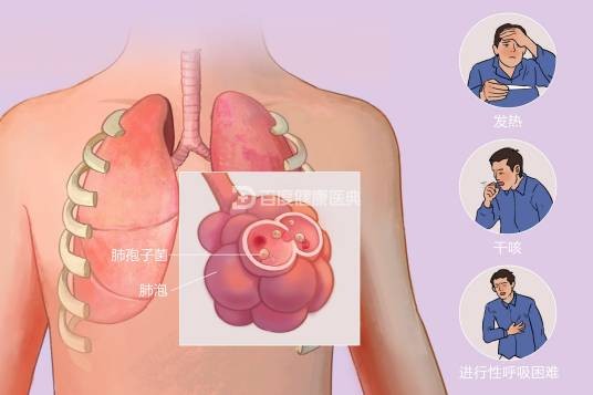 肺孢子菌肺炎