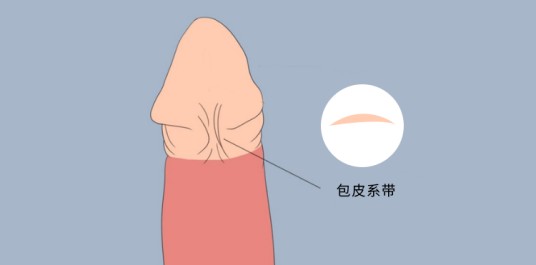 包皮系带手术