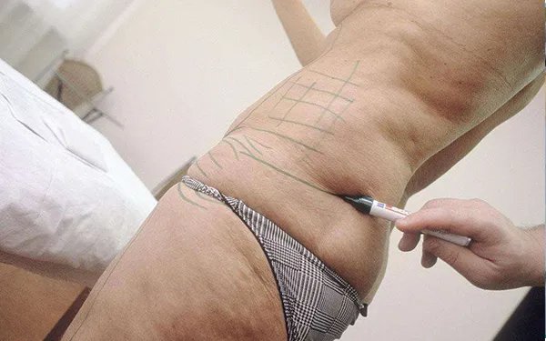 腰部吸脂减肥