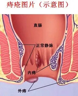 正常屁眼图与痔疮图片:女性痔疮图片,症状及其危害