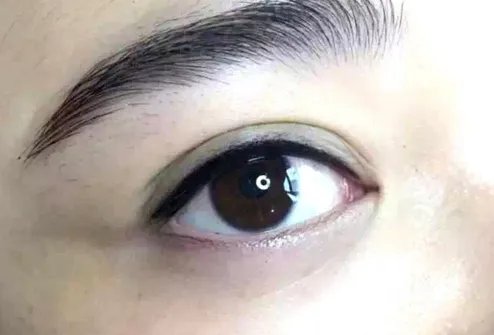去除眼袋的费用