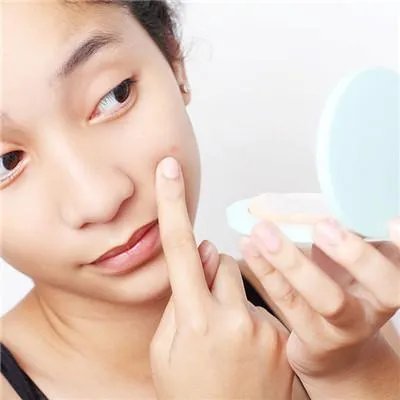 青春痘粉刺怎么治疗