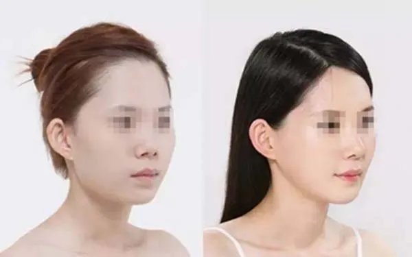 成都隆鼻哪家医院好