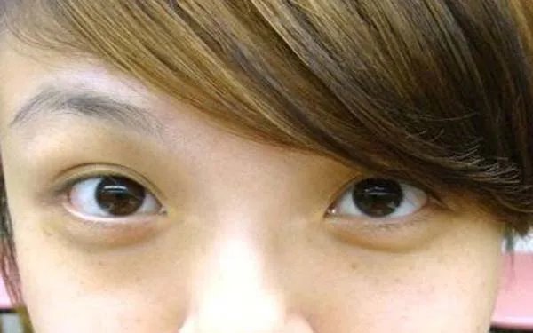 广州好的开眼角整形医院在哪