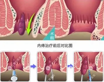 正常屁眼图与痔疮图片:女性痔疮图片,症状及其危害