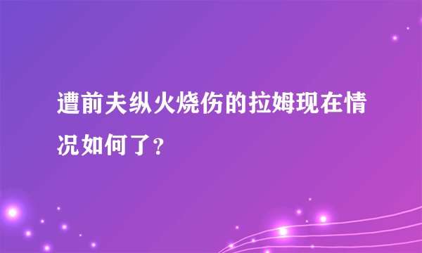遭前夫纵火烧伤的拉姆现在情况如何了？