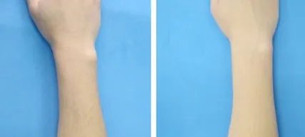 脱毛哪个永久