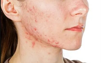 做祛痘需要多少钱?费用是多少?