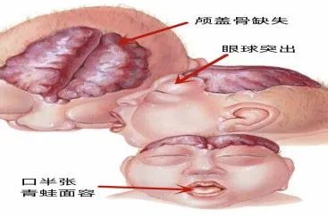 无脑儿图片