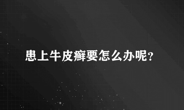 患上牛皮癣要怎么办呢？