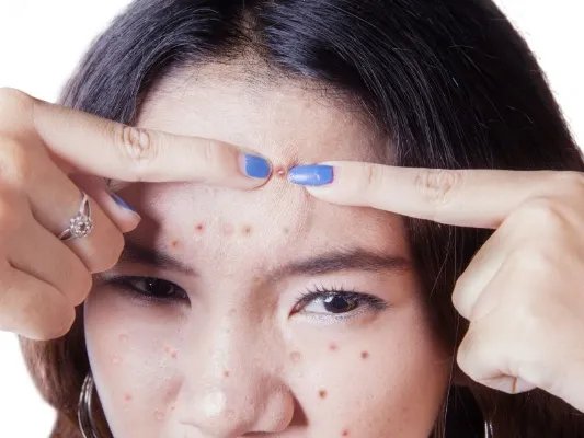 如何治疗额头上的痤疮