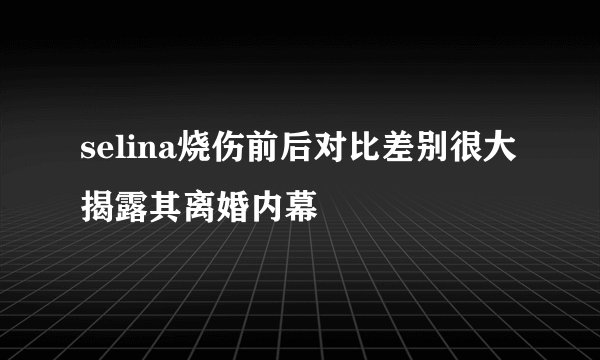 selina烧伤前后对比差别很大揭露其离婚内幕