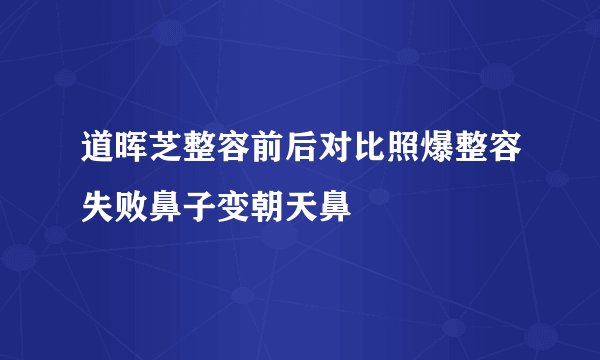 道晖芝整容前后对比照爆整容失败鼻子变朝天鼻
