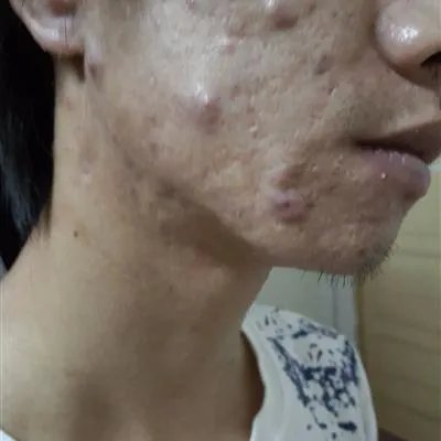 男生祛痘方法