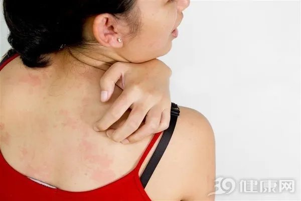 麻疹喜好湿冷环境 专家支招冬春如何防范麻疹侵袭