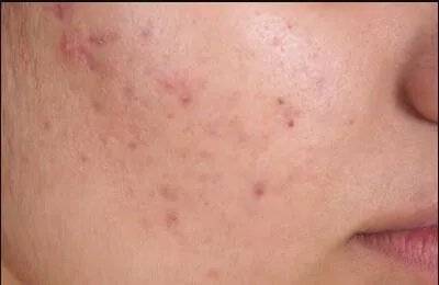 做祛痘需要多少钱?费用是多少?