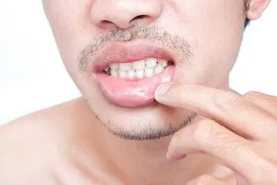 嘴唇上长单纯疱疹如何治疗