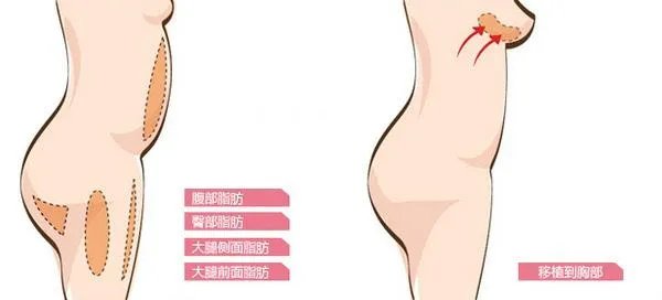 自体脂肪隆胸手术是如何操作的?
